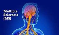 متخصص مغز و اعصاب در دانشگاه علوم پزشکی خراسان شمالی عنوان کرد:ام‌اس پایان زندگی نیست، تشخیص زودهنگام و درمان به‌موقع، مسیر بیماری را تغییر می‌دهد